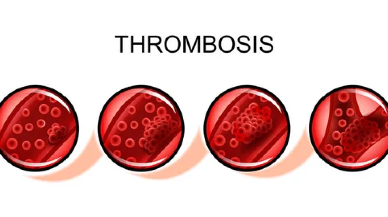 Trombosis Venosa Dalam: Kondisi Serius yang Perlu Diwaspadai